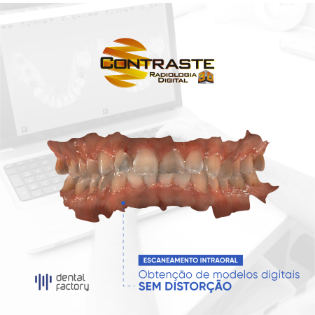 Escaneamento Intra Oral